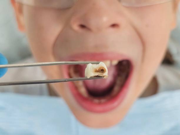 Best Emergency Treatment for Oral Infections in Maryland City, MD